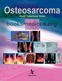 Image of Osteosarcoma